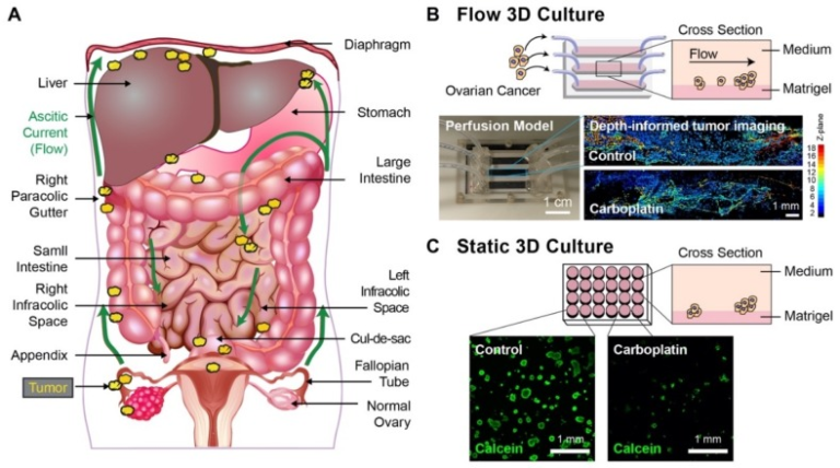 Figure 1 (A) A schematic of ovarian cancer metastases involving tumor ...